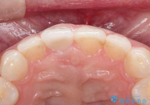 【オールセラミッククラウン】他院で入れた被せものがすぐとれるの治療後
