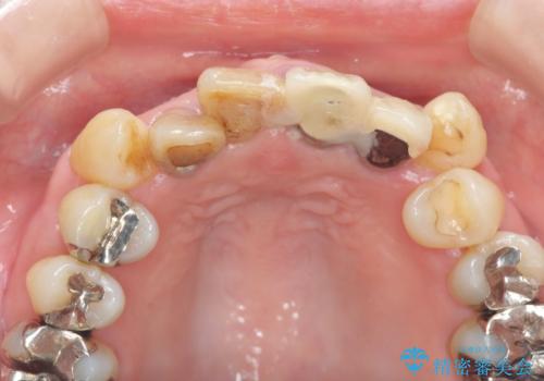 前歯をきれいにしたいの治療前