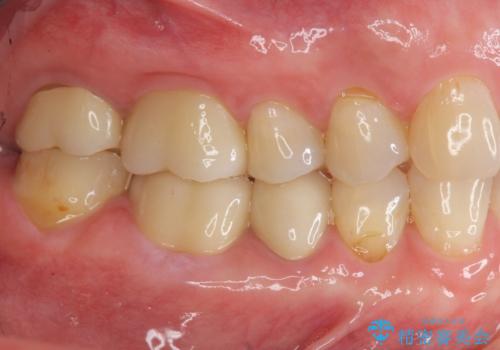 口腔内をメタルフリーにしたいの治療後