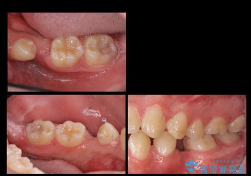 生まれつき歯が少ない　20代でインプラント治療の症例 治療前