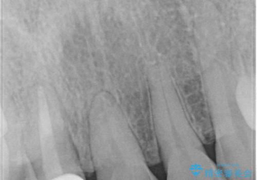 【オールセラミッククラウン】他院で入れた被せものがすぐとれるの治療後