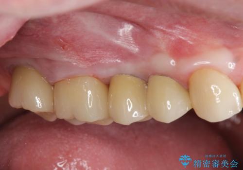[ インプラントによる機能回復 ]     強い咬合力　放置した虫歯の治療の症例 治療後