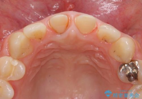 前歯をきれいにしたいの治療中