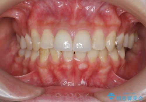 前歯をきれいにしたいの治療後