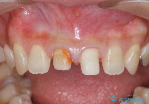 前歯をきれいにしたいの治療中