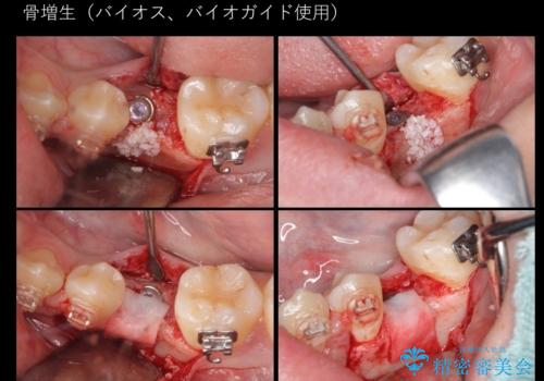 生まれつき歯が少ない 20代でインプラント治療の治療中