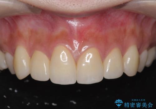 [ 前歯のセラミック治療 ]   短期間で歯並びを治したいの治療後