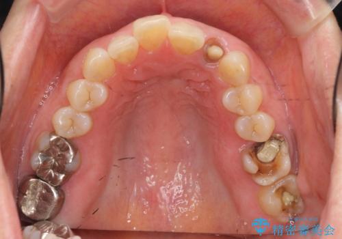 口腔内をメタルフリーにしたいの治療前