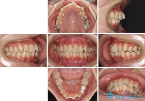 デコボコで磨きにくい前歯をスッキリと インビザライン矯正の治療前
