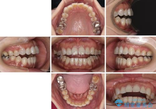 極端な上下前歯の開咬を改善　オープンバイトのインビザライン矯正の治療前