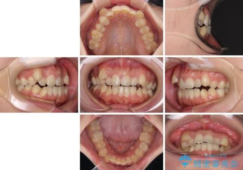八重歯を抜歯矯正でスッキリと メタルブラケットでの矯正治療の治療前