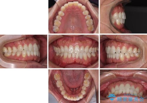 内側にある歯が干渉する　上顎前歯の部分矯正の治療前