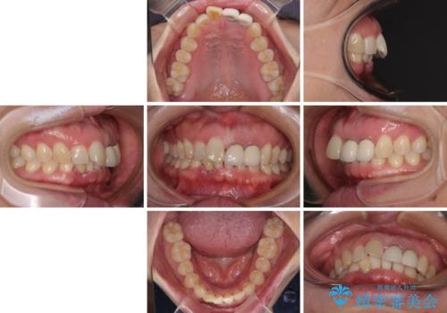 前歯のインプラント治療　折角なので矯正治療できれいな歯並びにの治療前