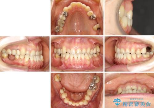 反対咬合や欠損を治療したい インビザライン矯正とオールセラミックブリッジの治療前