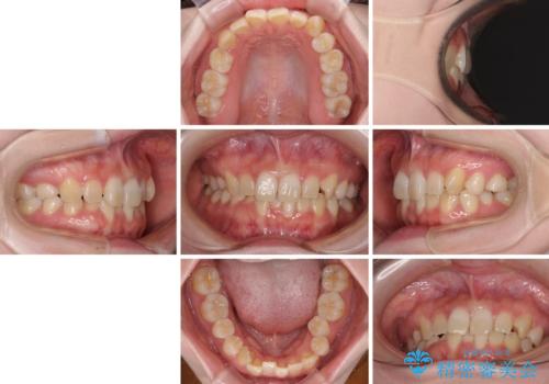 ディープバイトをインビザライン矯正で改善の治療前