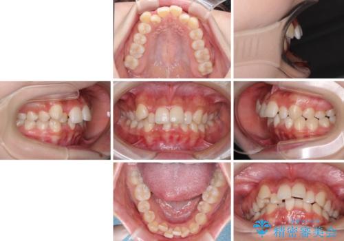 【モニター】八重歯とデコボコをスッキリきれいに ワイヤー装置での抜歯矯正の治療前