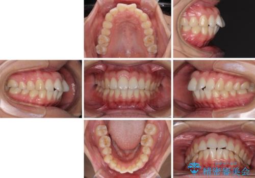 前歯の出っ歯と口の閉じにくさが気になる 目立たないワイヤー装置での抜歯矯正の治療前