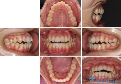 受け口と開咬を急速拡大装置とワイヤー装置で改善の治療前