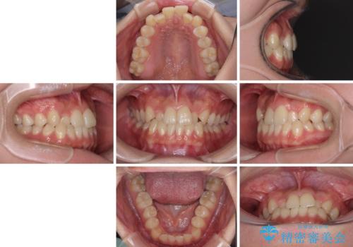 前歯のクロスバイトを短期間で解消 目立たないワイヤー矯正の治療前