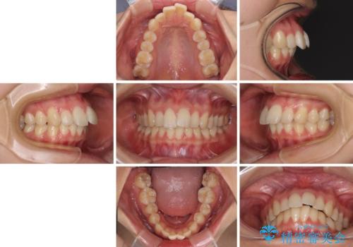 【モニター】飛び出した上顎前歯のワイヤー矯正で改善の治療前
