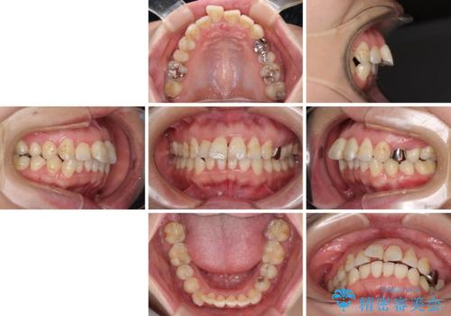 出っ歯による口の閉じにくさを治したい　ワイヤー装置を用いた抜歯矯正の治療前