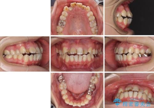 八重歯と開咬を治したい 目立たないハーフリンガル矯正の治療前