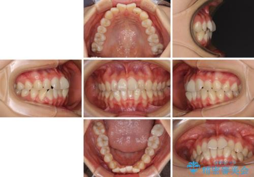 前歯のクロスバイト ワイヤー装置を併用したインビザライン矯正の治療前