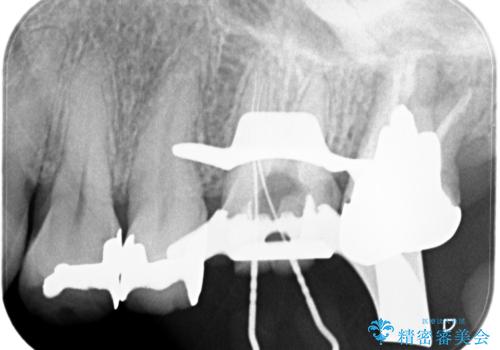 【根管治療】未処置根管を有した歯の再根管治療の治療中