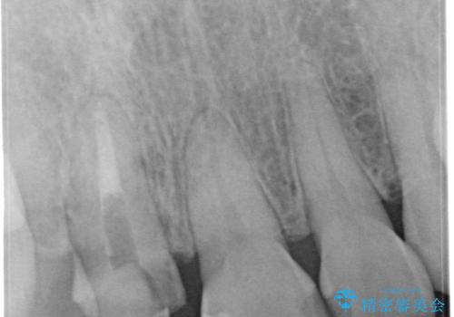 【オールセラミッククラウン】他院で入れた被せものがすぐとれるの治療前