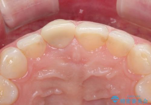 【オールセラミッククラウン】他院で入れた被せものがすぐとれるの治療前