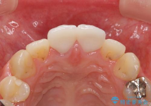 前歯をきれいにしたいの治療後