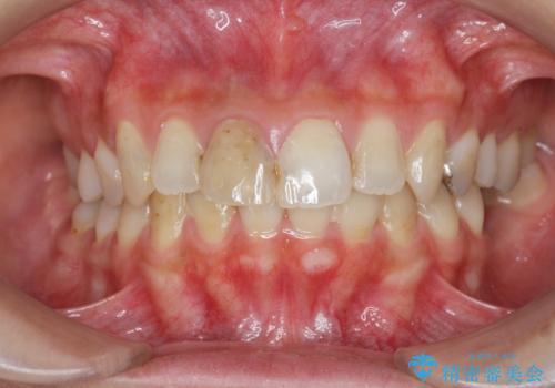 前歯をきれいにしたいの治療前