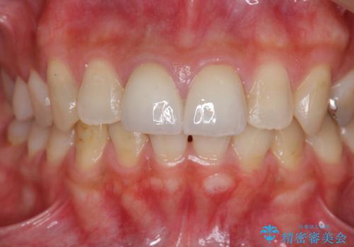前歯をきれいにしたいの治療後