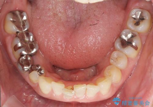 口腔内をメタルフリーにしたいの治療前