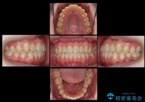 生まれつき歯が少ない 20代でインプラント治療の治療後