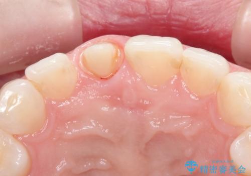 【オールセラミッククラウン】他院で入れた被せものがすぐとれるの治療中