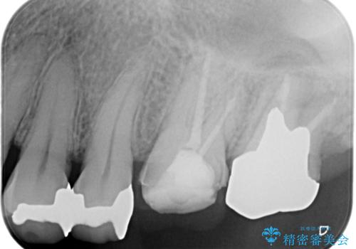 【根管治療】未処置根管を有した歯の再根管治療の治療前