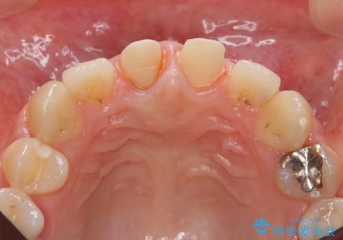 前歯をきれいにしたいの治療中