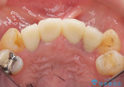 前歯をきれいにしたいの治療後