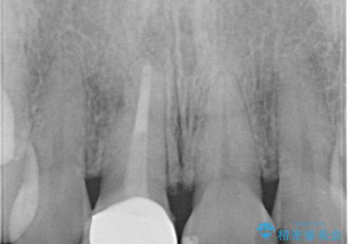 【オールセラミッククラウン】他院で入れた被せものがすぐとれるの治療後