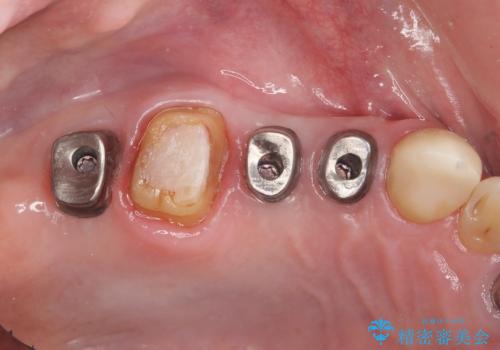 [ インプラントによる機能回復 ]     強い咬合力　放置した虫歯の治療の治療中