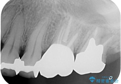 【根管治療】未処置根管を有した歯の再根管治療の治療後