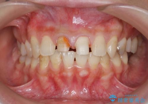 前歯をきれいにしたいの治療中