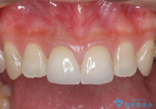 前歯をきれいにしたいの治療後