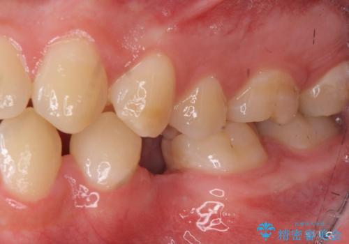 生まれつき歯が少ない 20代でインプラント治療