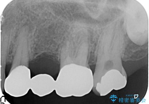 古くなった銀歯をやりかえたいの治療前