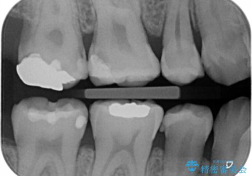 銀の詰め物を白い物にしたいの治療前