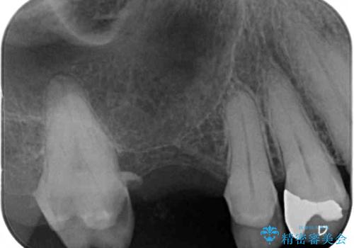 放置した奥歯の虫歯 セラミックブリッジによる補綴治療の治療前