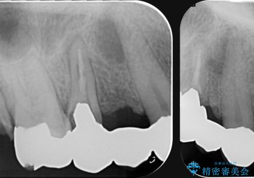 [ インプラントによる機能回復 ]     強い咬合力　放置した虫歯の治療の治療前