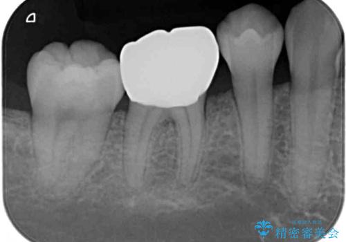 歯が欠けてしみる オールセラミッククラウンによる虫歯治療の治療後